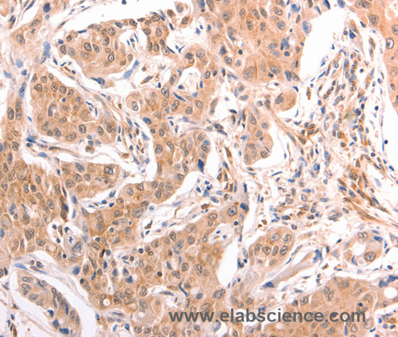 Immunohistochemistry of paraffin-embedded Human lung cancer tissue using TNF beta Polyclonal Antibody at dilution 1:50