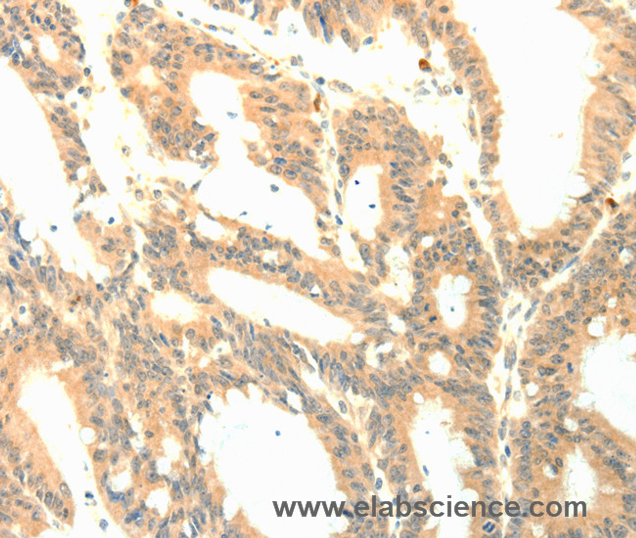 Immunohistochemistry of paraffin-embedded Human colon cancer tissue using P23 Polyclonal Antibody at dilution 1:50