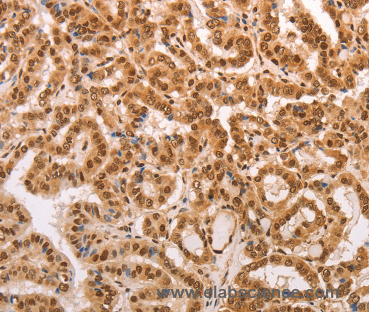 Immunohistochemistry of paraffin-embedded Human thyroid cancer tissue using HEXIM1 Polyclonal Antibody at dilution 1:65