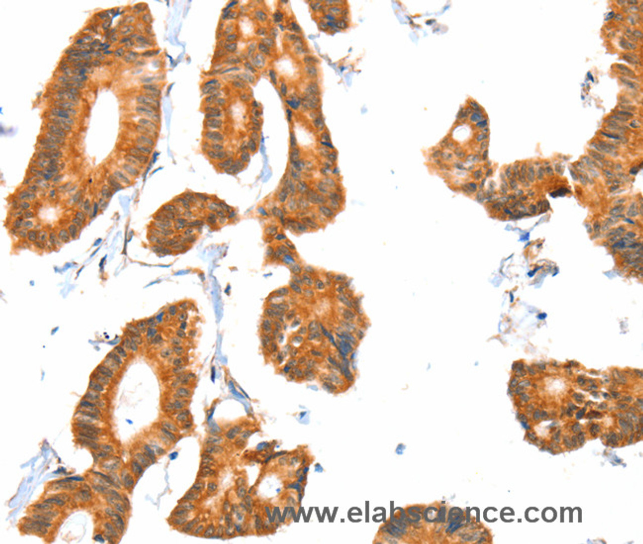 Immunohistochemistry of paraffin-embedded Human colon cancer tissue using ACOX1 Polyclonal Antibody at dilution 1:40