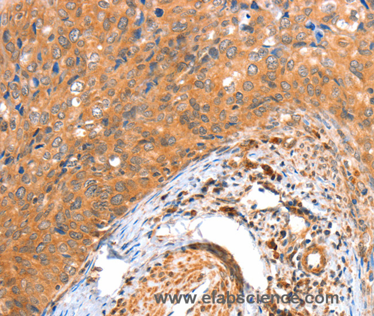 Immunohistochemistry of paraffin-embedded Human cervical cancer tissue using ACOX3 Polyclonal Antibody at dilution 1:35