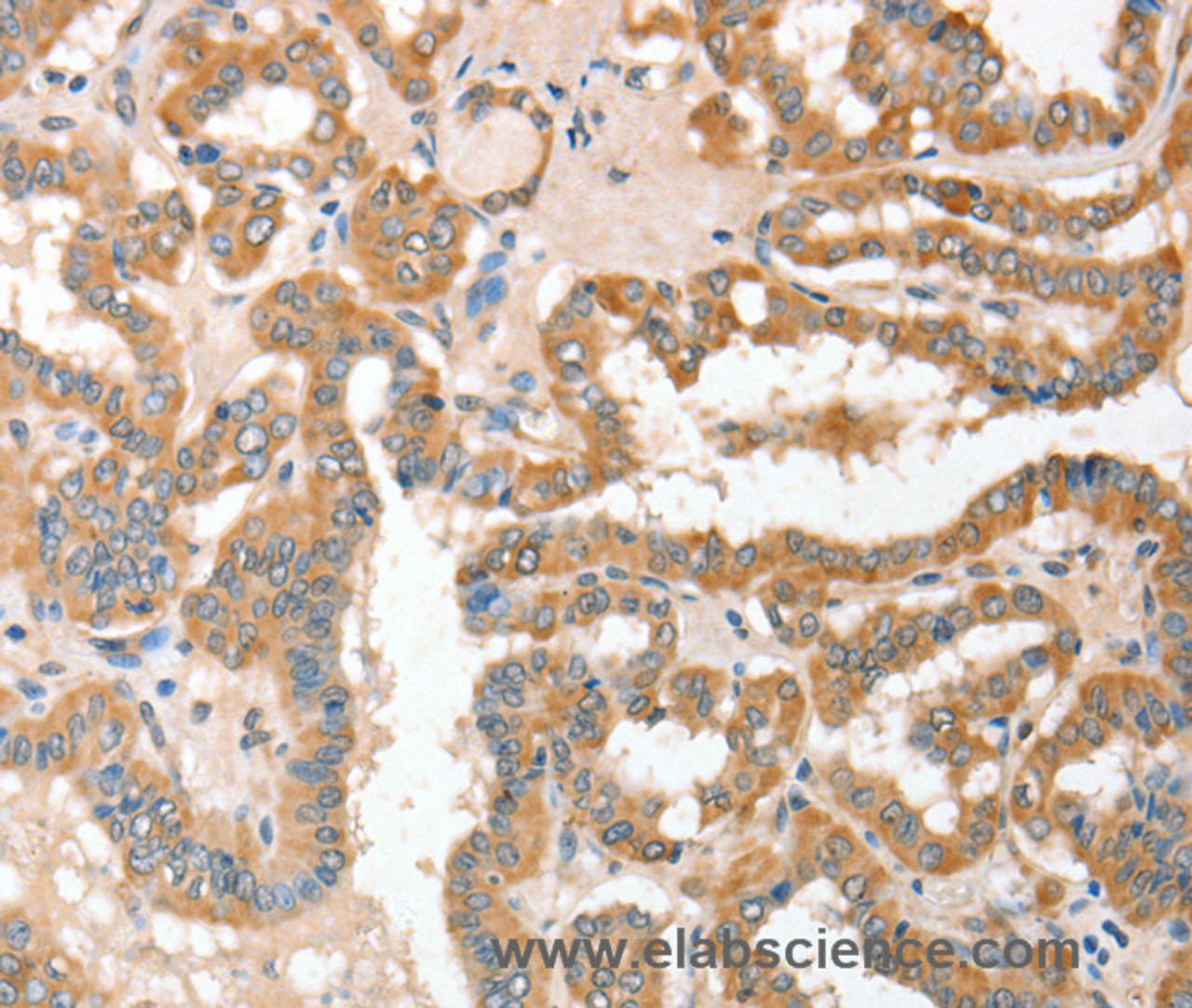 Immunohistochemistry of paraffin-embedded Human thyroid cancer using CD156c Polyclonal Antibody at dilution of 1:30