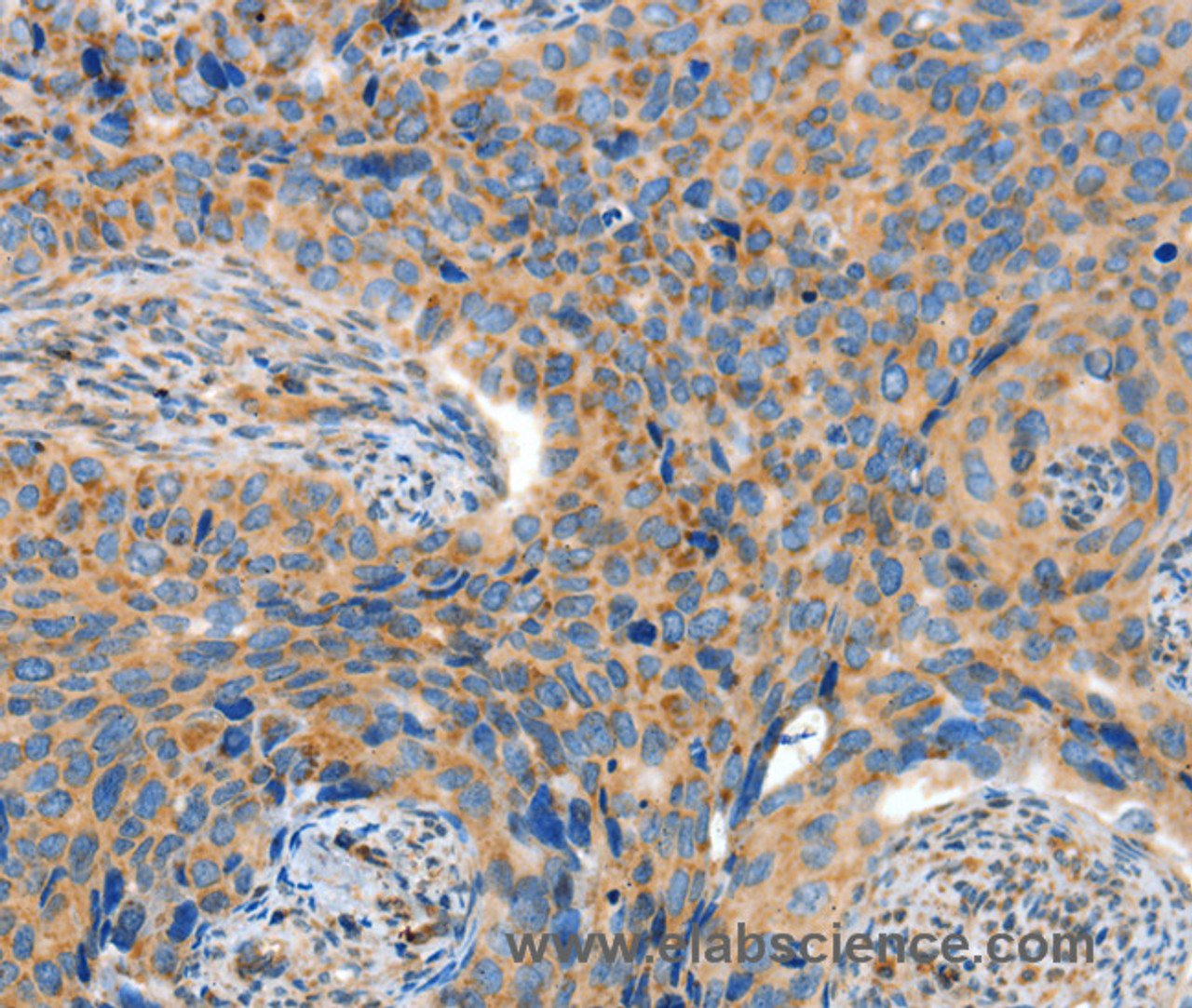 Immunohistochemistry of paraffin-embedded Human cervical cancer tissue using ADAMTS18 Polyclonal Antibody at dilution 1:30