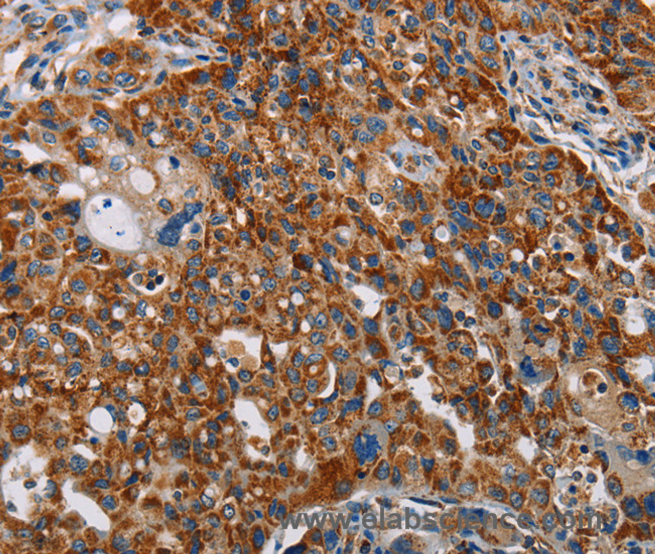Immunohistochemistry of paraffin-embedded Human lung cancer tissue using ALG2 Polyclonal Antibody at dilution 1:35