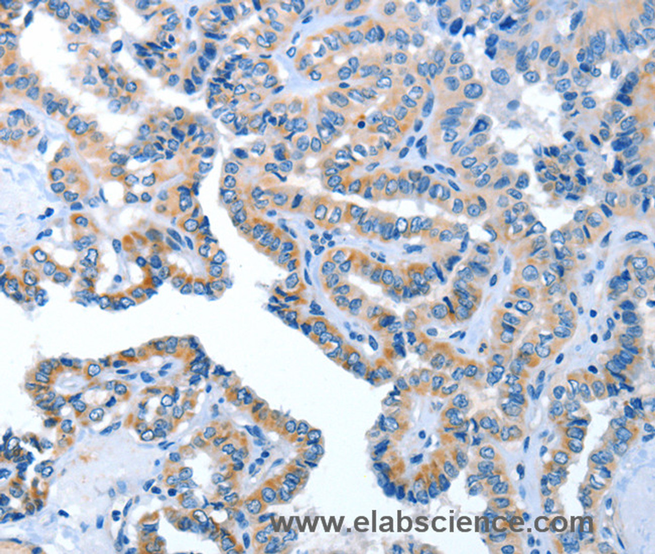 Immunohistochemistry of paraffin-embedded Human thyroid cancer using AMDHD2 Polyclonal Antibody at dilution of 1:40