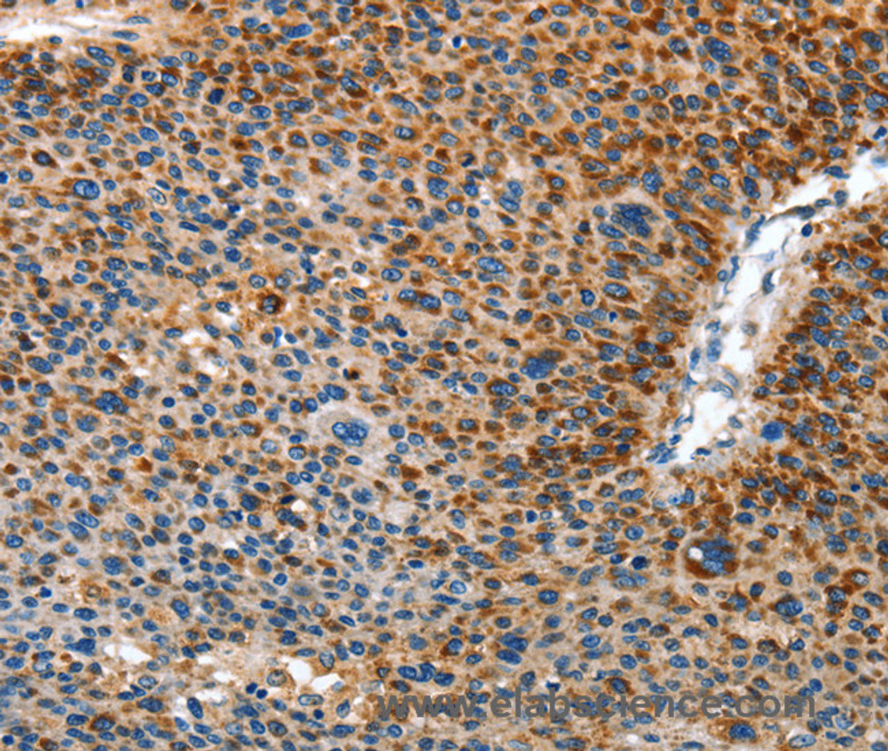 Immunohistochemistry of paraffin-embedded Human liver cancer using AMDHD2 Polyclonal Antibody at dilution of 1:40