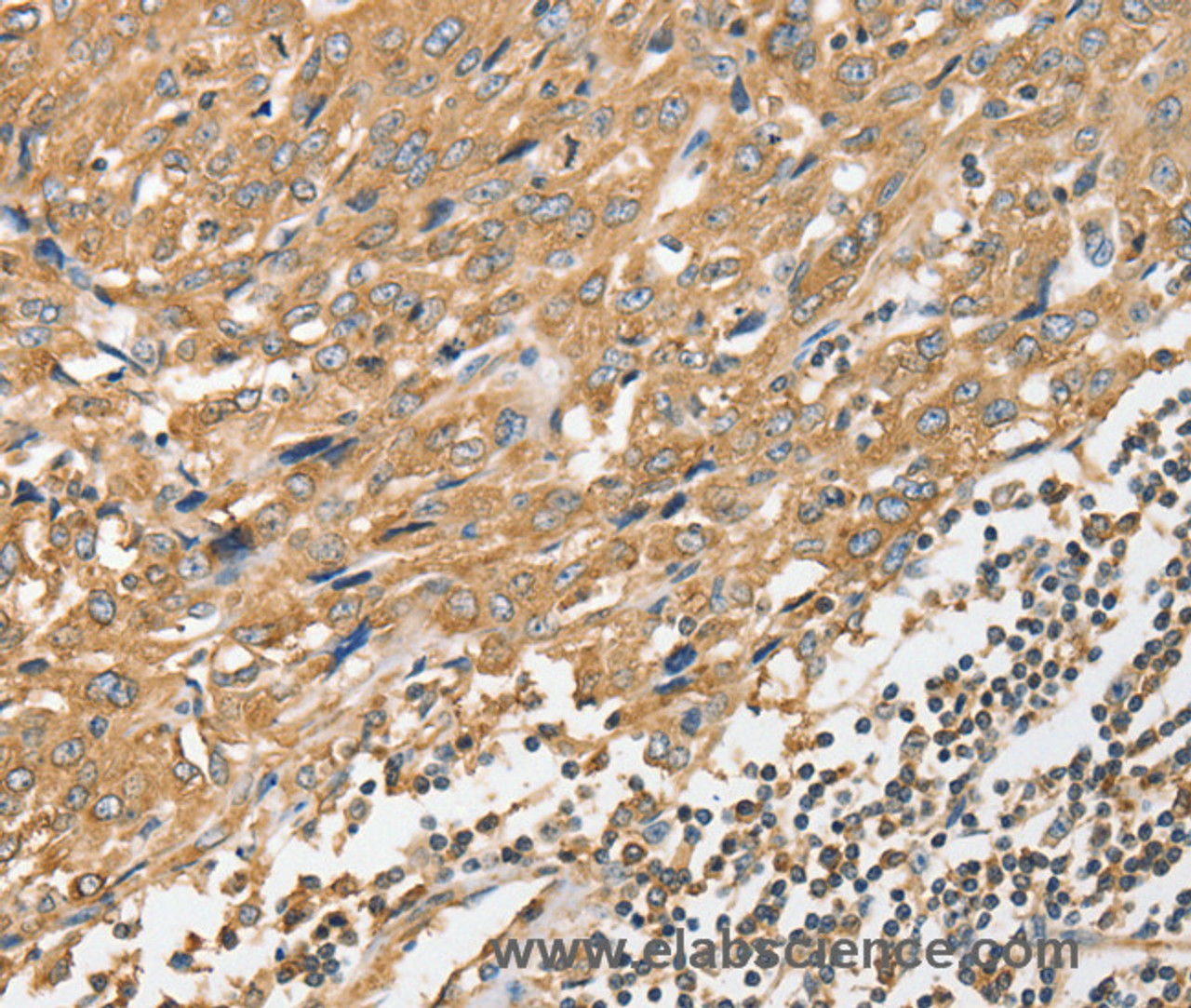 Immunohistochemistry of paraffin-embedded Human esophagus cancer tissue using ANGPTL7 Polyclonal Antibody at dilution 1:40