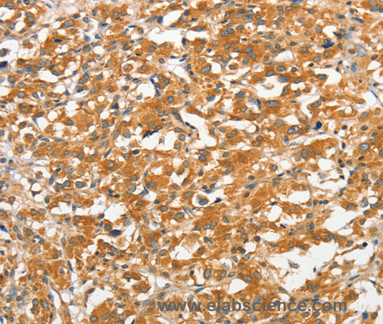 Immunohistochemistry of paraffin-embedded Human thyroid cancer tissue using ANKMY2 Polyclonal Antibody at dilution 1:30