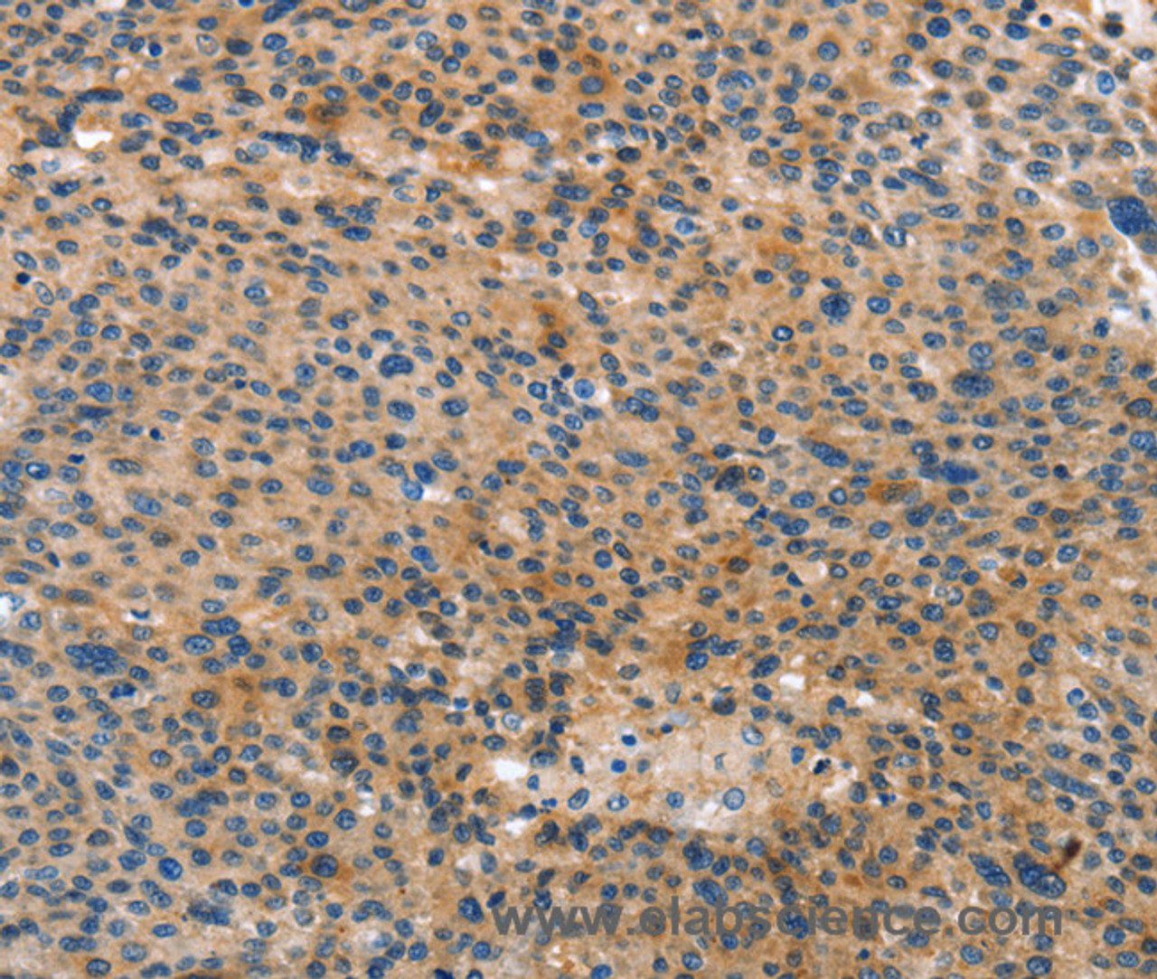 Immunohistochemistry of paraffin-embedded Human liver cancer tissue using ANXA10 Polyclonal Antibody at dilution 1:35