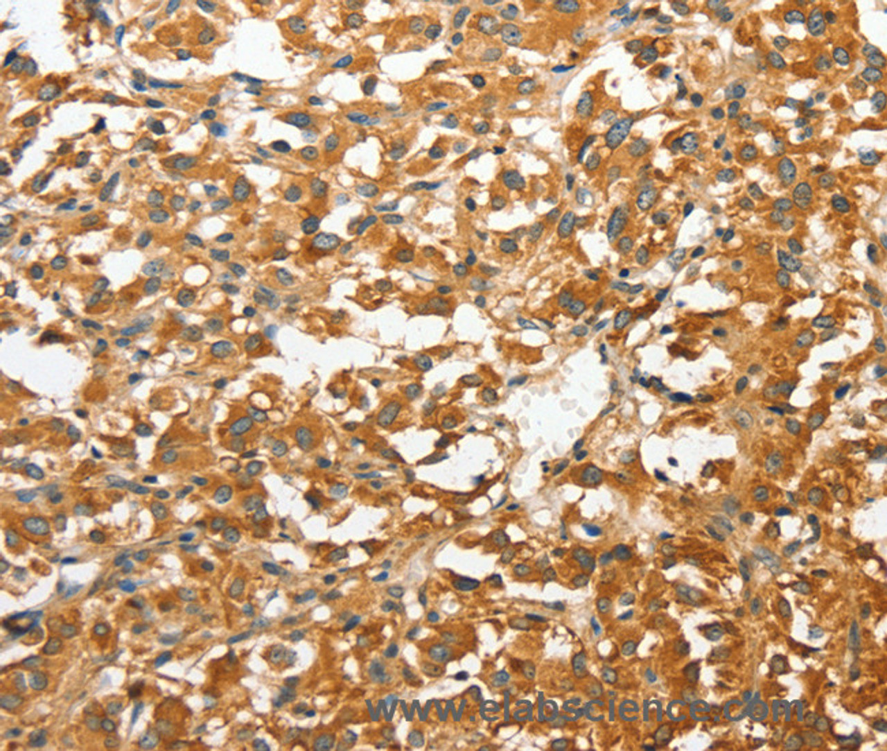 Immunohistochemistry of paraffin-embedded Human thyroid cancer tissue using ANXA9 Polyclonal Antibody at dilution 1:30