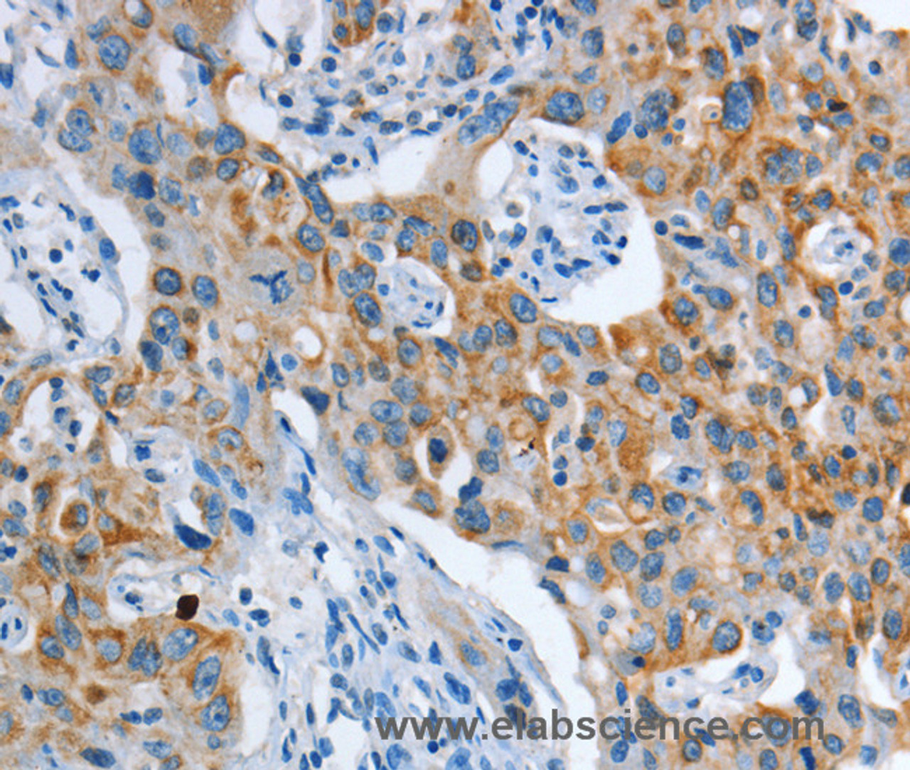 Immunohistochemistry of paraffin-embedded Human lung cancer tissue using ASL Polyclonal Antibody at dilution 1:35