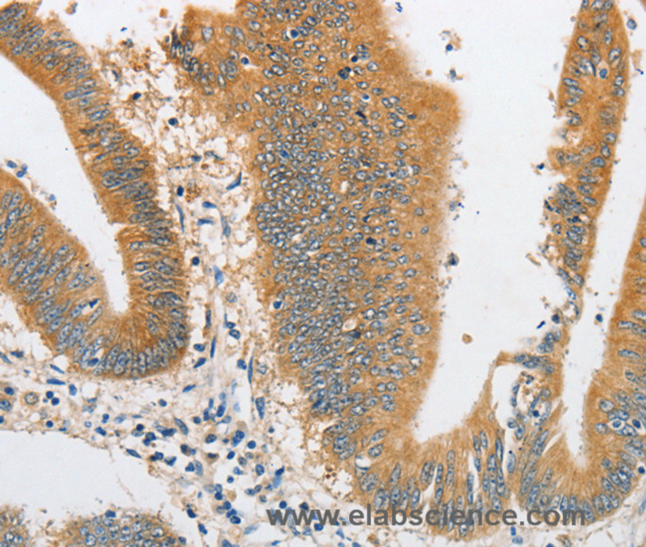 Immunohistochemistry of paraffin-embedded Human colon cancer tissue using ARHGAP5 Polyclonal Antibody at dilution 1:30