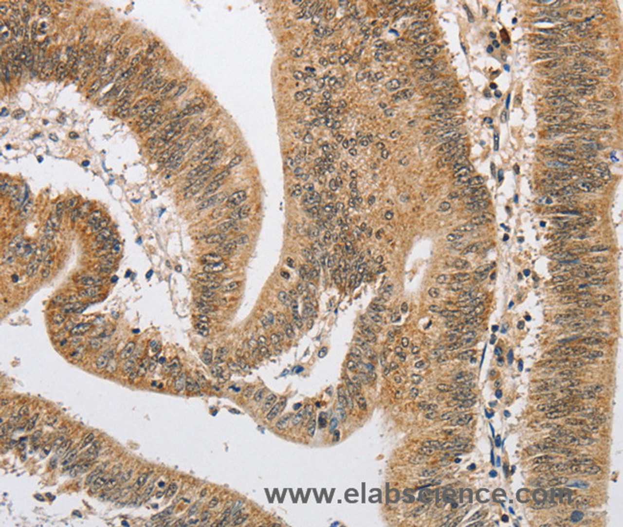 Immunohistochemistry of paraffin-embedded Human colon cancer using ARHGAP25 Polyclonal Antibody at dilution of 1:40