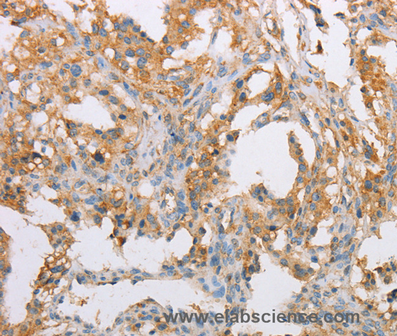 Immunohistochemistry of paraffin-embedded Human thyroid cancer tissue using ACTR2 Polyclonal Antibody at dilution 1:40