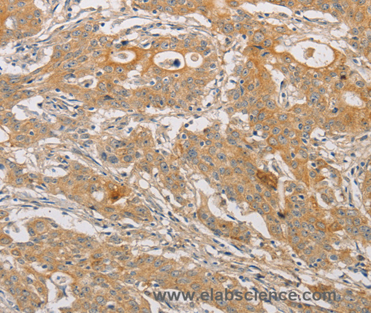 Immunohistochemistry of paraffin-embedded Human gasrtic cancer tissue using ARSK Polyclonal Antibody at dilution 1:30