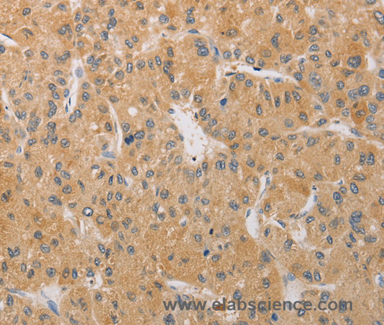 Immunohistochemistry of paraffin-embedded Human liver cancer tissue using ARSK Polyclonal Antibody at dilution 1:30