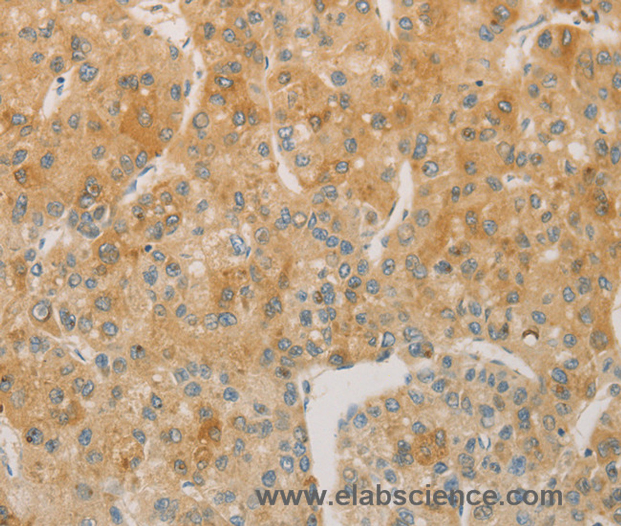 Immunohistochemistry of paraffin-embedded Human liver cancer using ACSL4 Polyclonal Antibody at dilution of 1:60