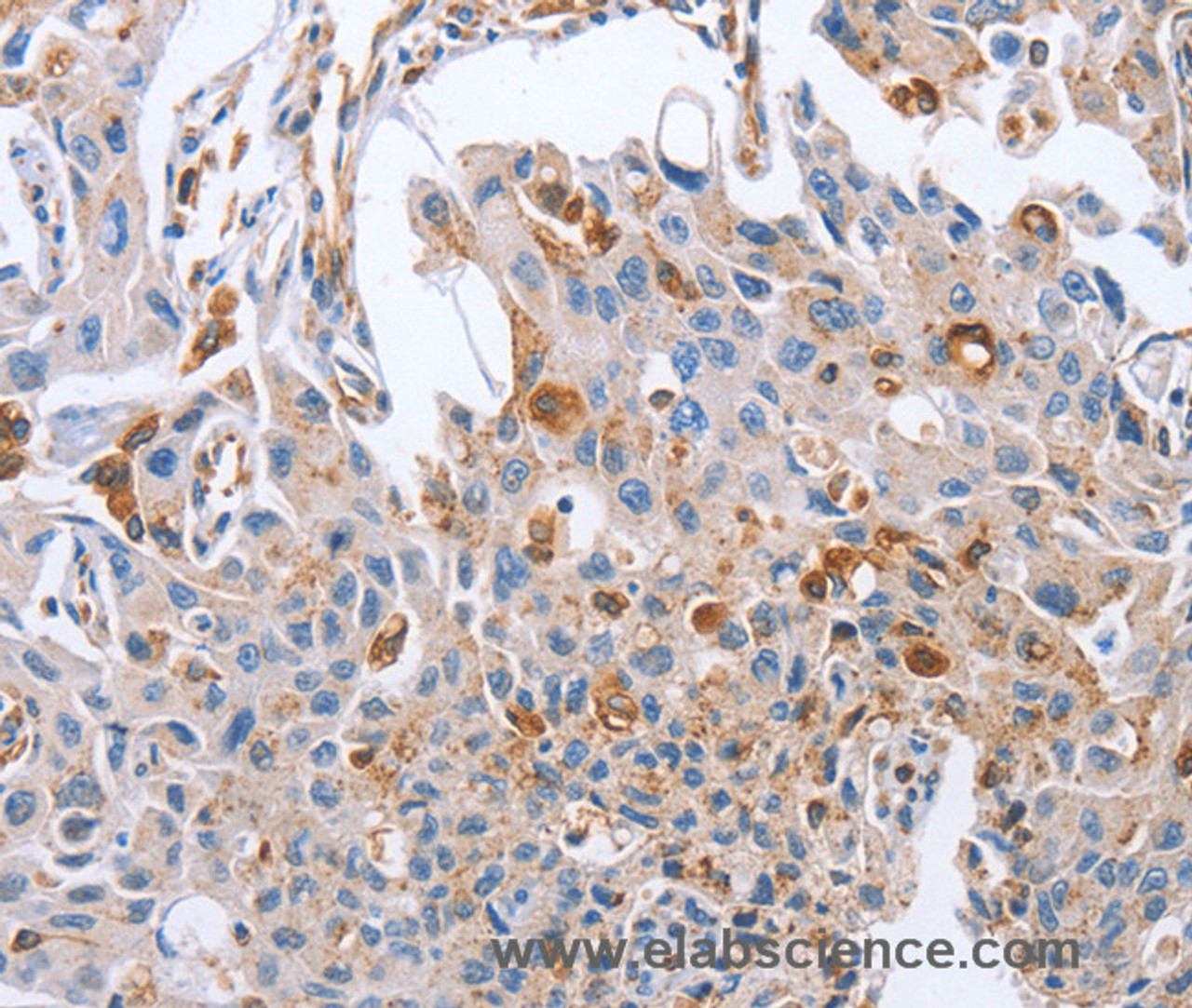 Immunohistochemistry of paraffin-embedded Human lung cancer tissue using NRG4 Polyclonal Antibody at dilution 1:60