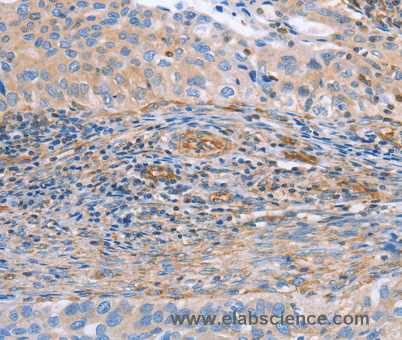 Immunohistochemistry of paraffin-embedded Human cervical cancer tissue using NRG4 Polyclonal Antibody at dilution 1:60
