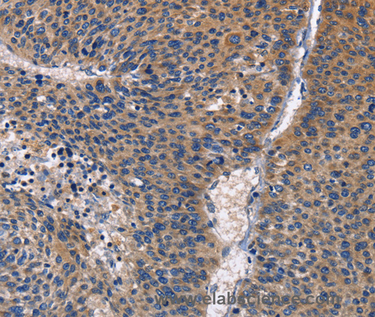 Immunohistochemistry of paraffin-embedded Human liver cancer using PKC delta Polyclonal Antibody at dilution of 1:30