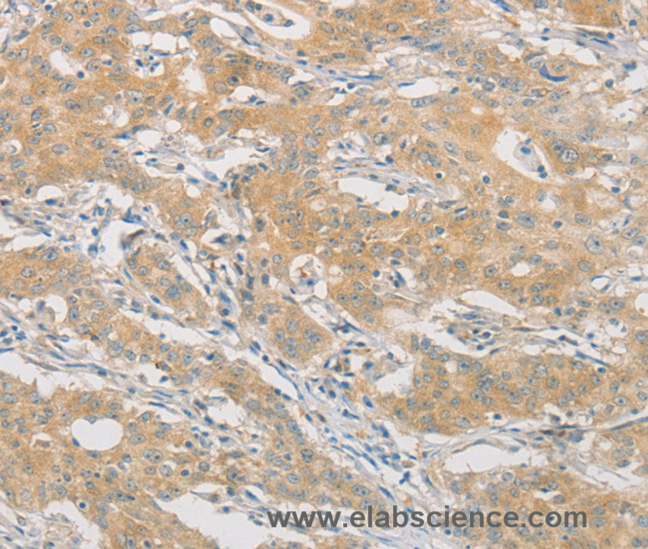 Immunohistochemistry of paraffin-embedded Human gasrtic cancer tissue using HIPK4 Polyclonal Antibody at dilution 1:30