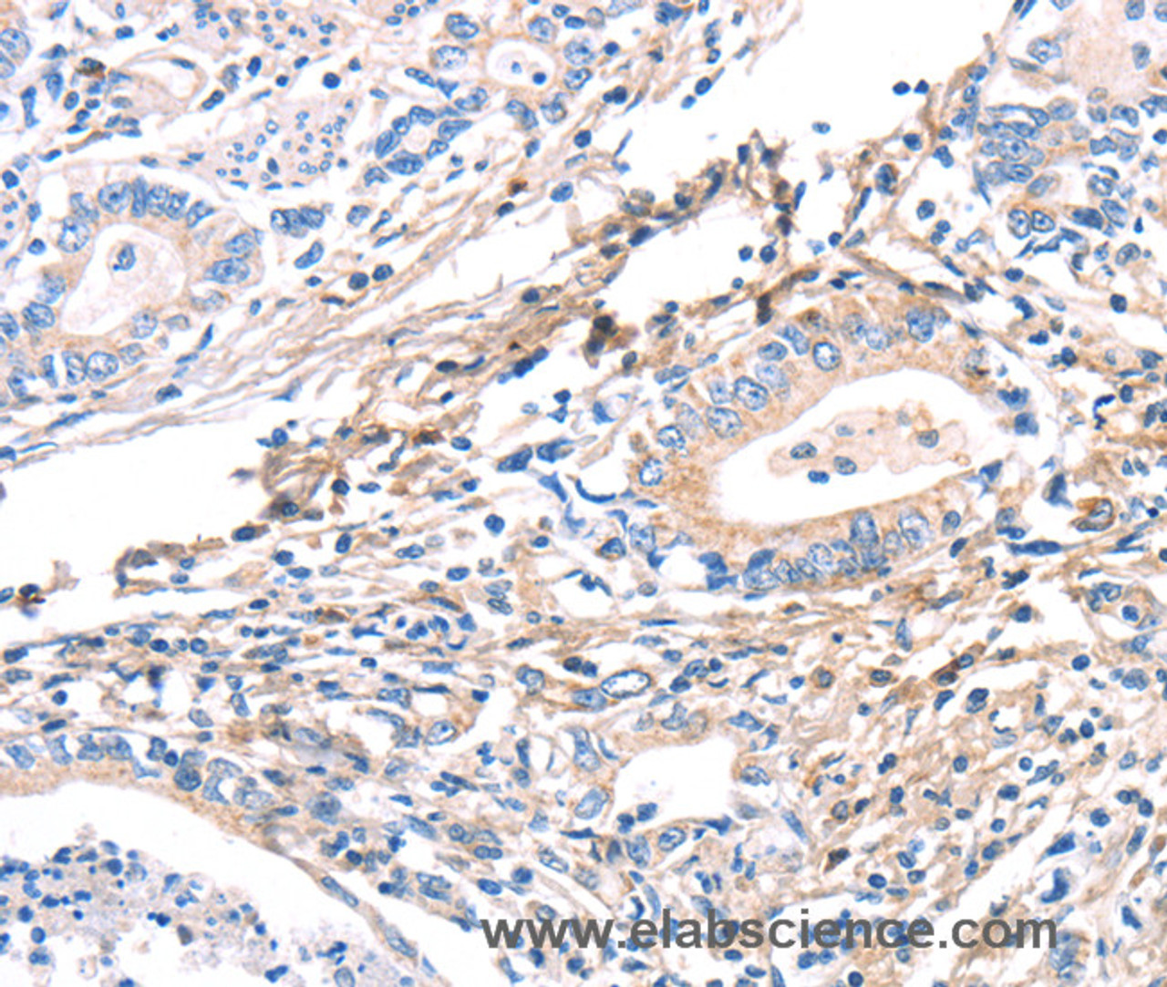 Immunohistochemistry of paraffin-embedded Human gastric cancer using TWF2 Polyclonal Antibody at dilution of 1:40