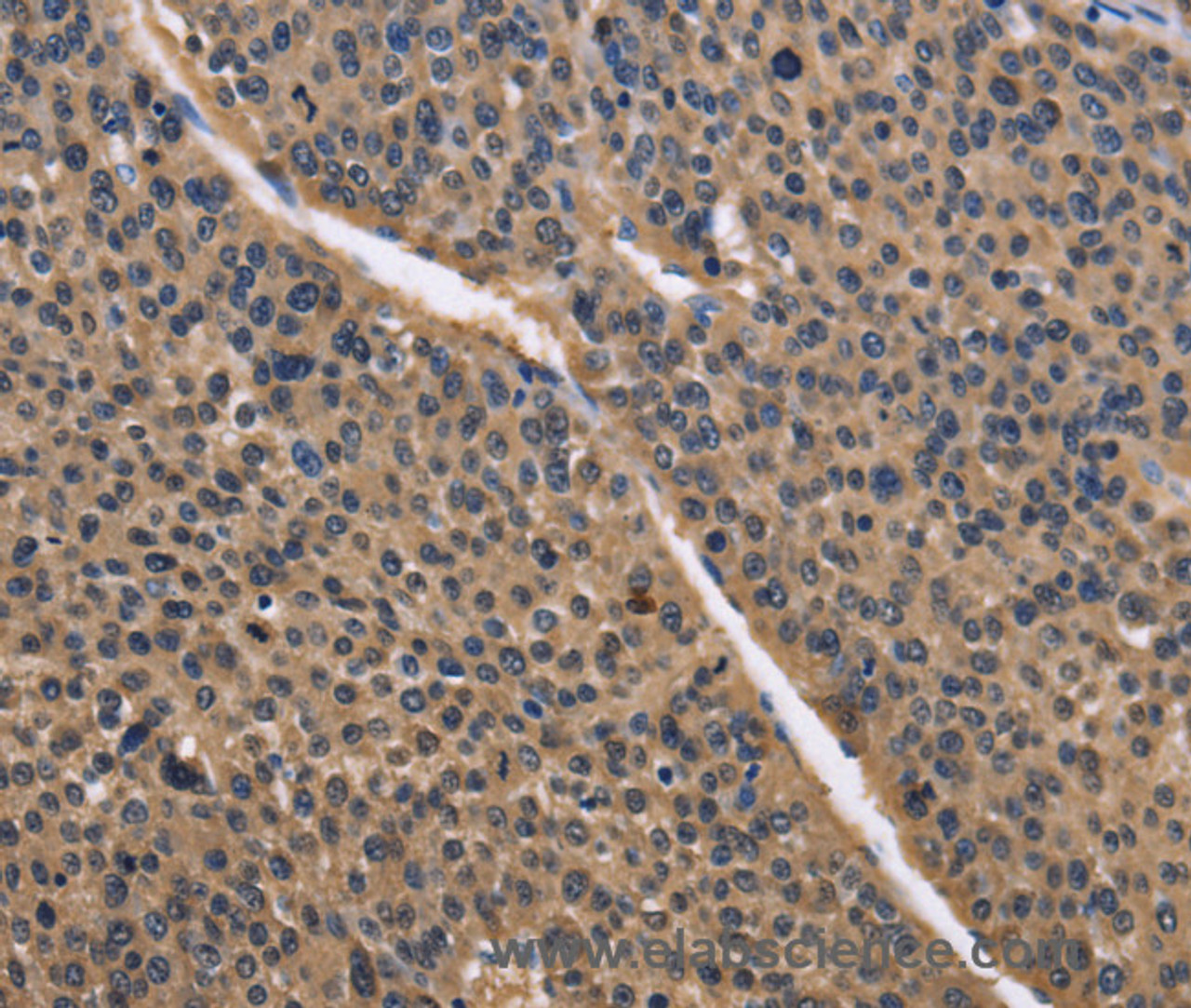 Immunohistochemistry of paraffin-embedded Human liver cancer using IDH1 Polyclonal Antibody at dilution of 1:50