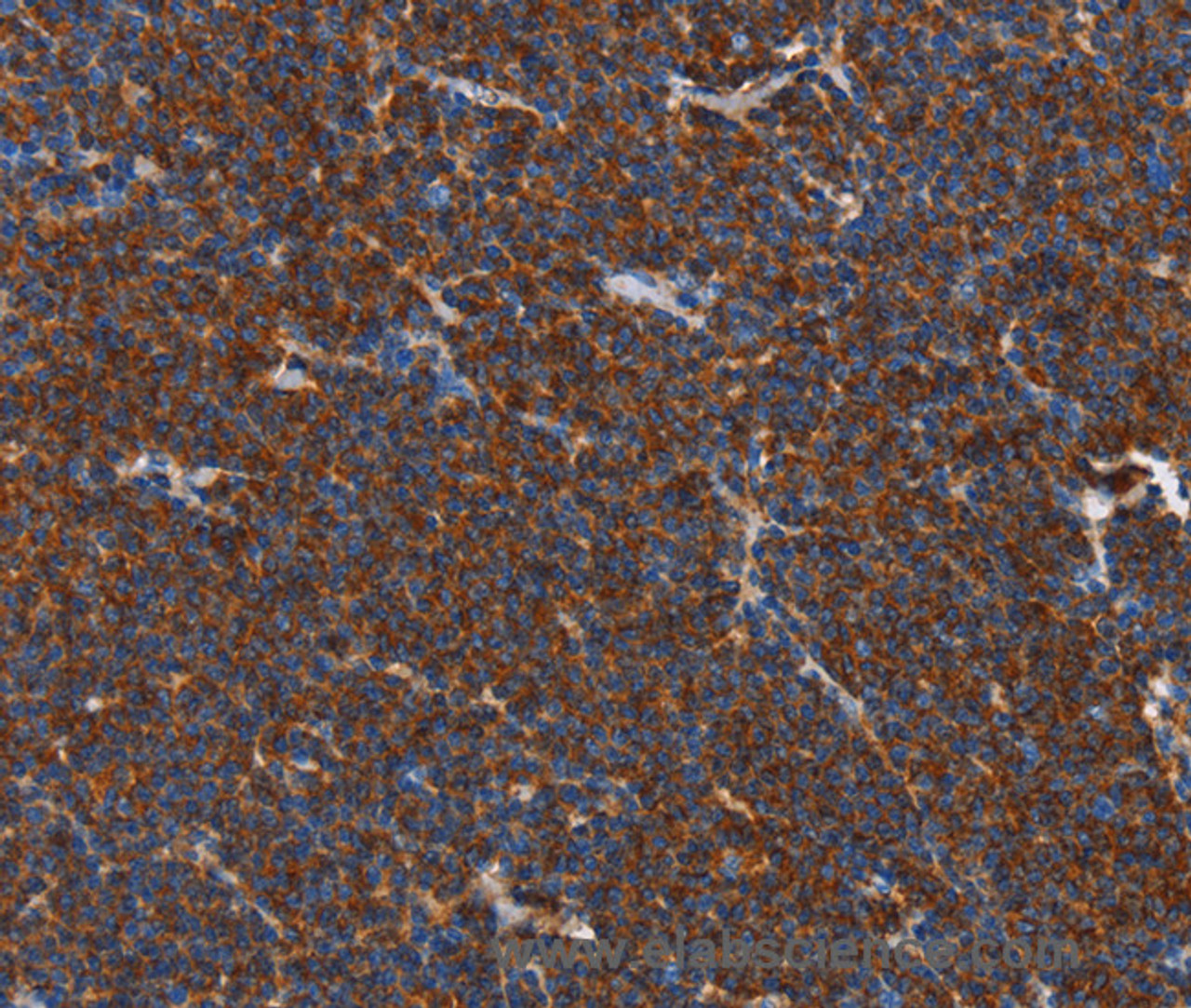 Immunohistochemistry of paraffin-embedded Human lymphoma tissue using FNK Polyclonal Antibody at dilution 1:40