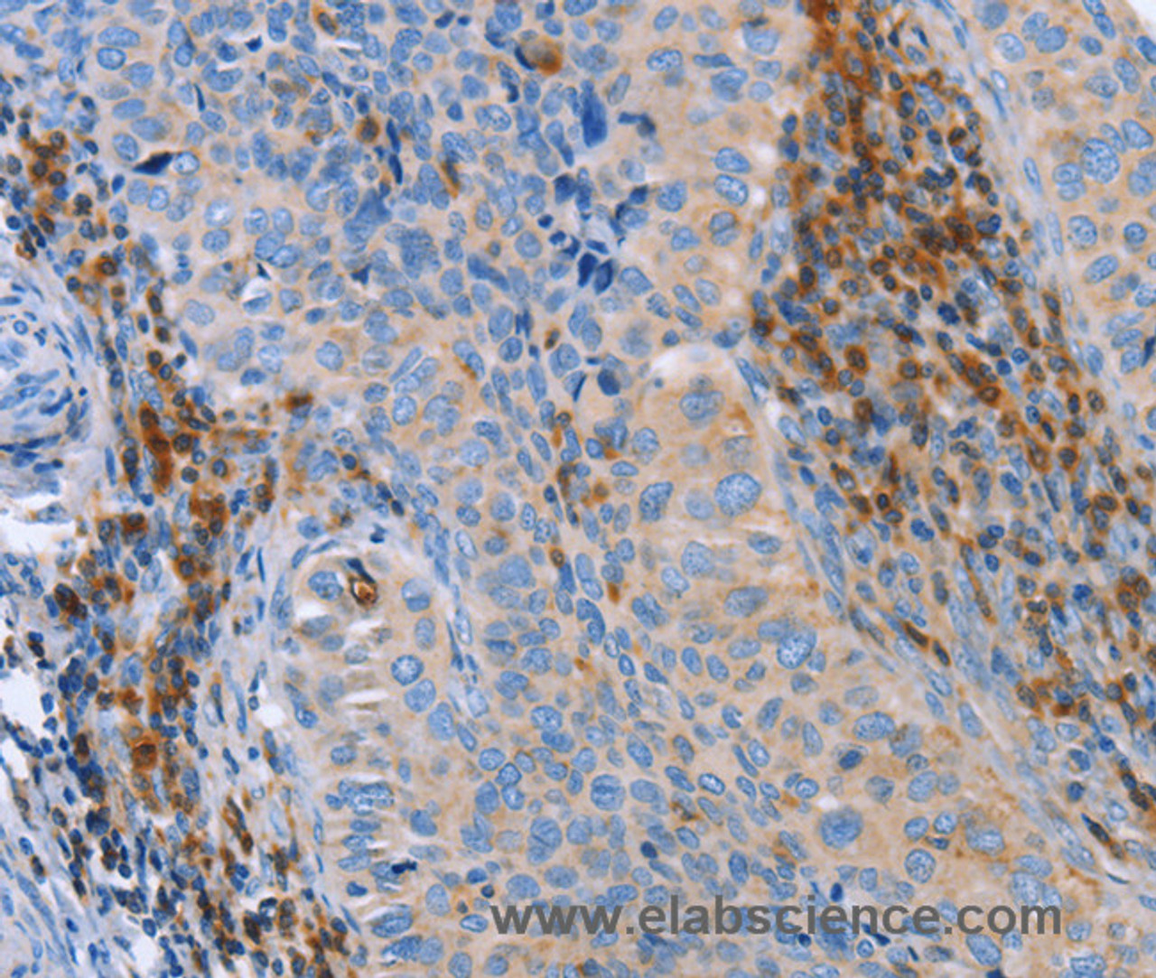 Immunohistochemistry of paraffin-embedded Human cervical cancer tissue using FNK Polyclonal Antibody at dilution 1:40