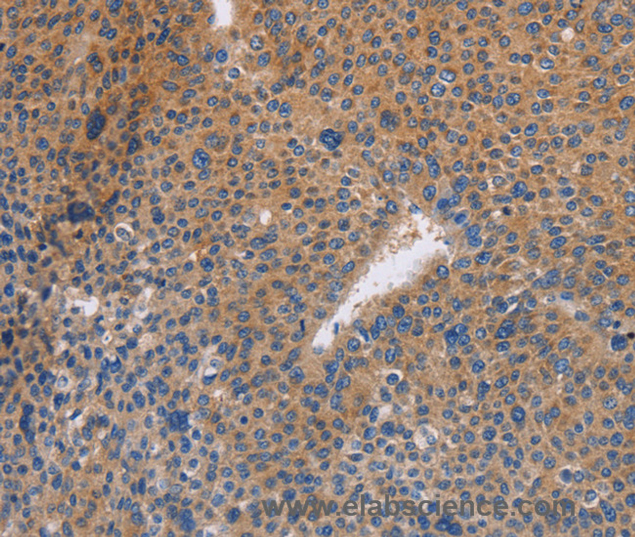 Immunohistochemistry of paraffin-embedded Human liver cancer tissue using NEK8 Polyclonal Antibody at dilution 1:30