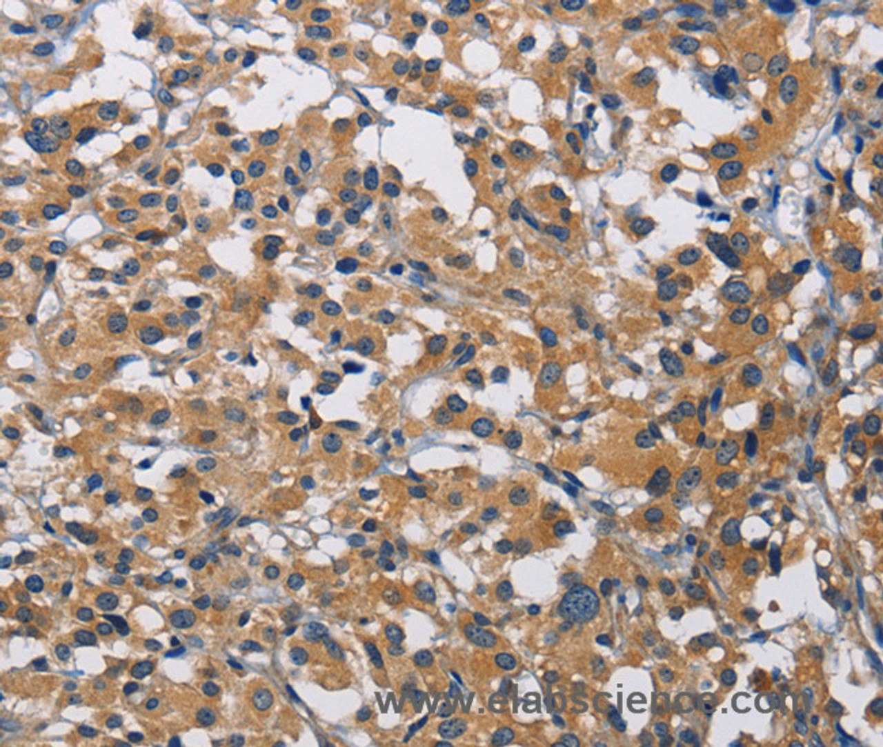 Immunohistochemistry of paraffin-embedded Human thyroid cancer tissue using CST4 Polyclonal Antibody at dilution 1:60