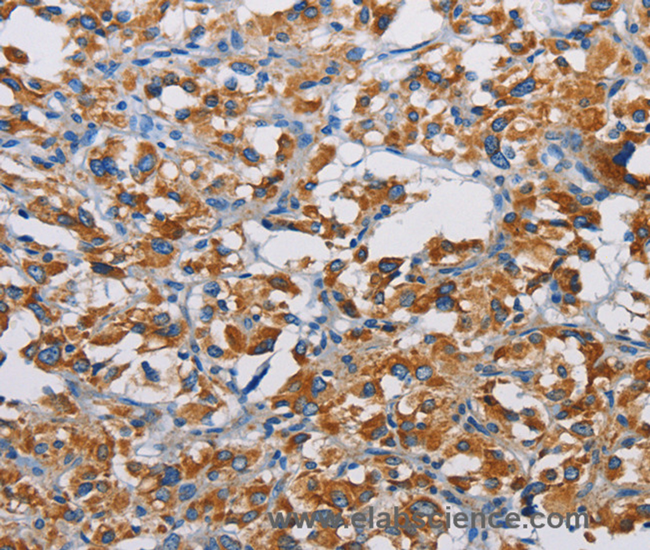 Immunohistochemistry of paraffin-embedded Human thyroid cancer tissue using TSPEAR Polyclonal Antibody at dilution 1:50