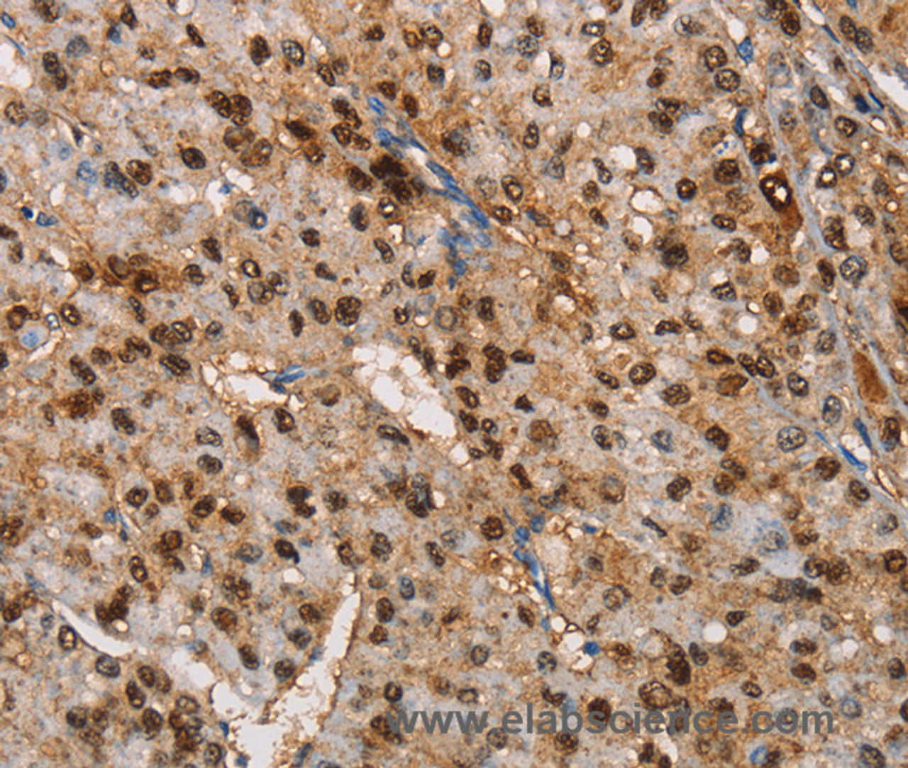 Immunohistochemistry of paraffin-embedded Human liver cancer tissue using TSPEAR Polyclonal Antibody at dilution 1:50
