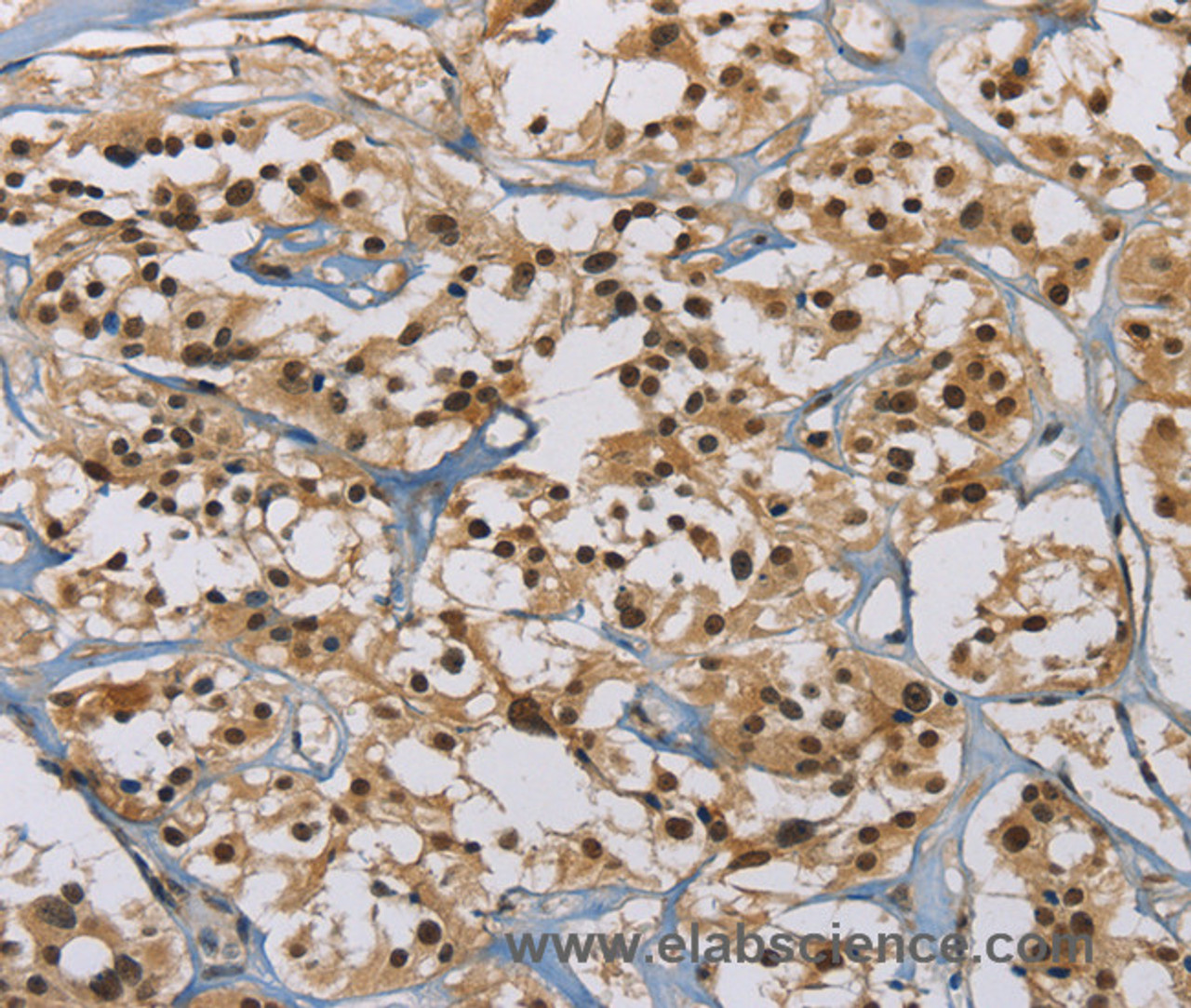 Immunohistochemistry of paraffin-embedded Human thyroid cancer tissue using ACVR1 Polyclonal Antibody at dilution 1:60