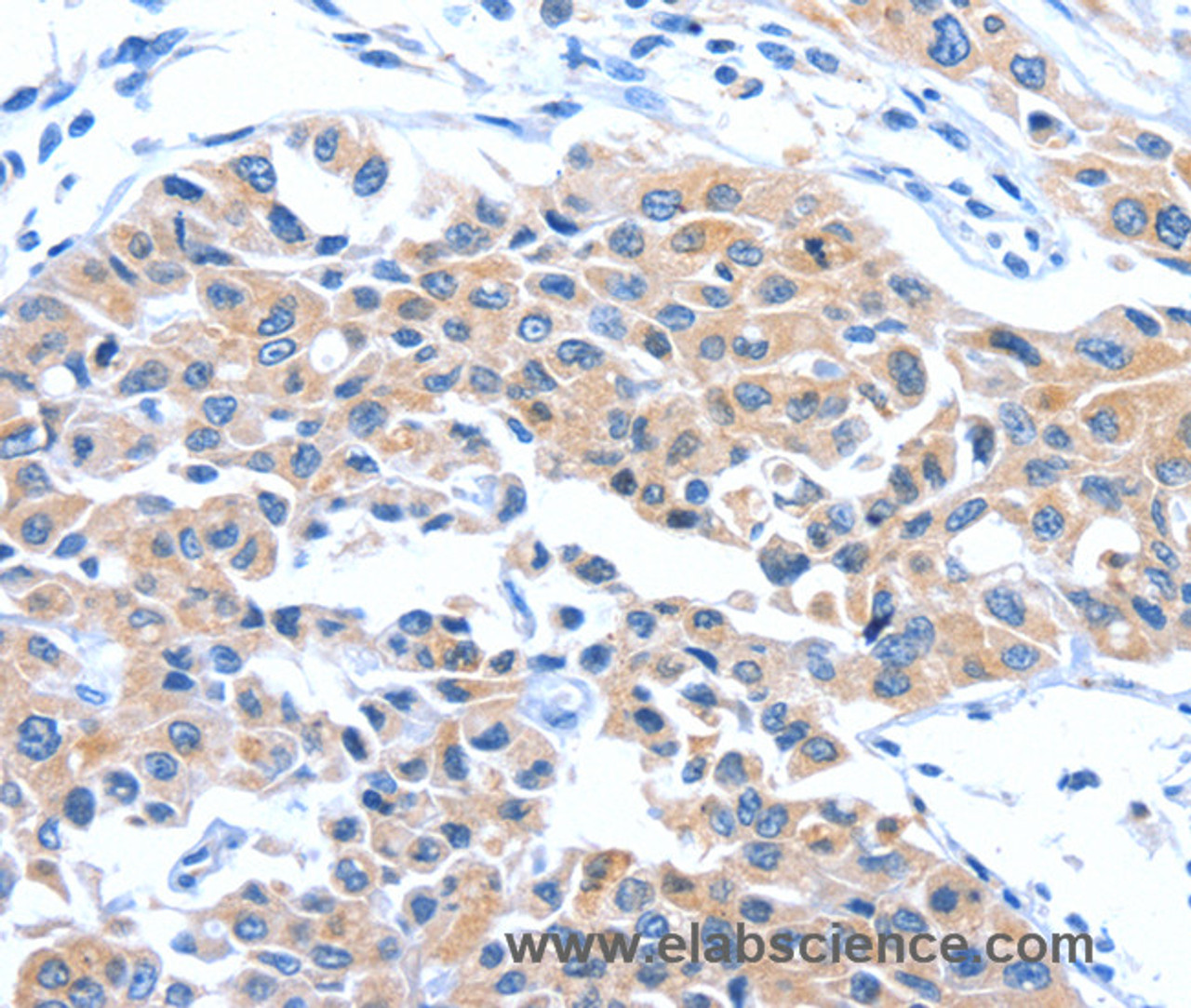 Immunohistochemistry of paraffin-embedded Human lung cancer tissue using ARL11 Polyclonal Antibody at dilution 1:50