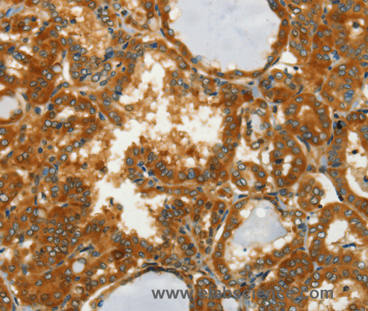 Immunohistochemistry of paraffin-embedded Human thyroid cancer using GOT1 Polyclonal Antibody at dilution of 1:50