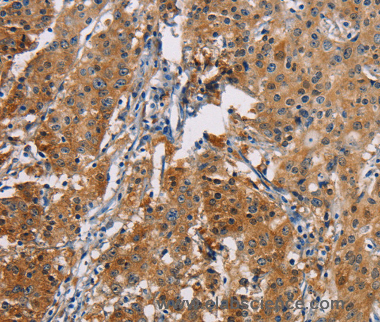 Immunohistochemistry of paraffin-embedded Human gastric cancer tissue using PDCD1LG2 Polyclonal Antibody at dilution 1:50