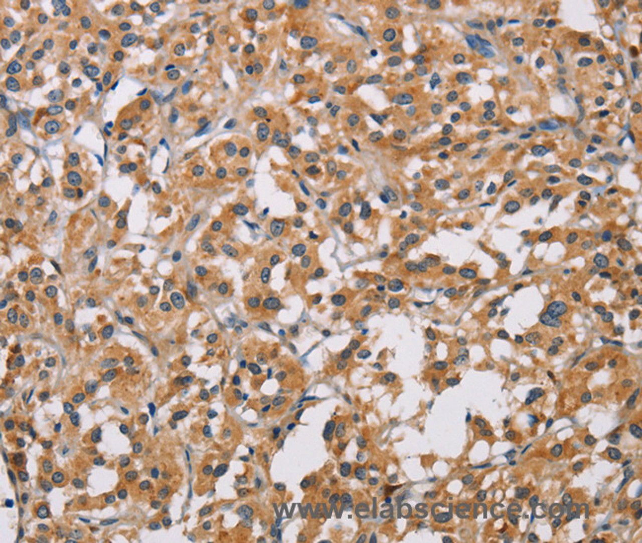 Immunohistochemistry of paraffin-embedded Human thyroid cancer tissue using PDCD1LG2 Polyclonal Antibody at dilution 1:50
