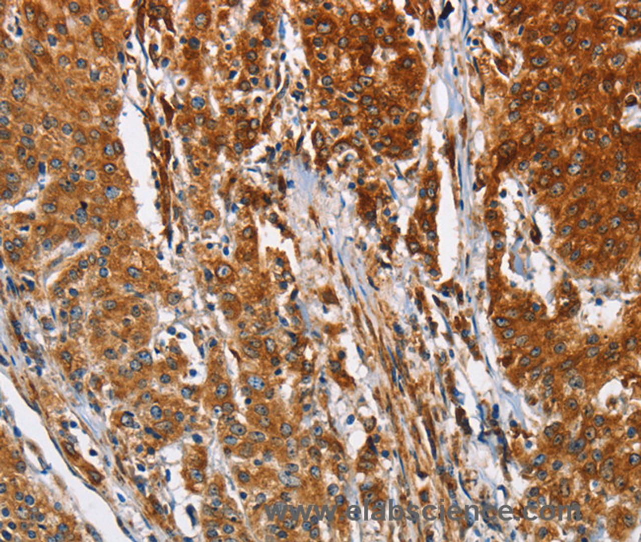 Immunohistochemistry of paraffin-embedded Human gastic cancer using BCAP31 Polyclonal Antibody at dilution of 1:30