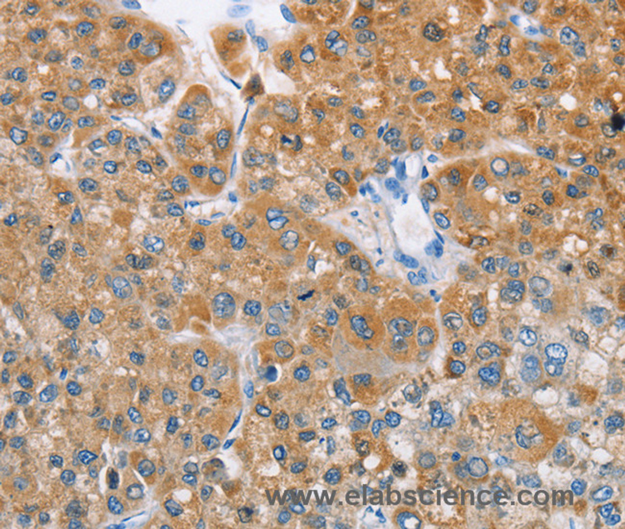 Immunohistochemistry of paraffin-embedded Human liver cancer tissue using BDH1 Polyclonal Antibody at dilution 1:60