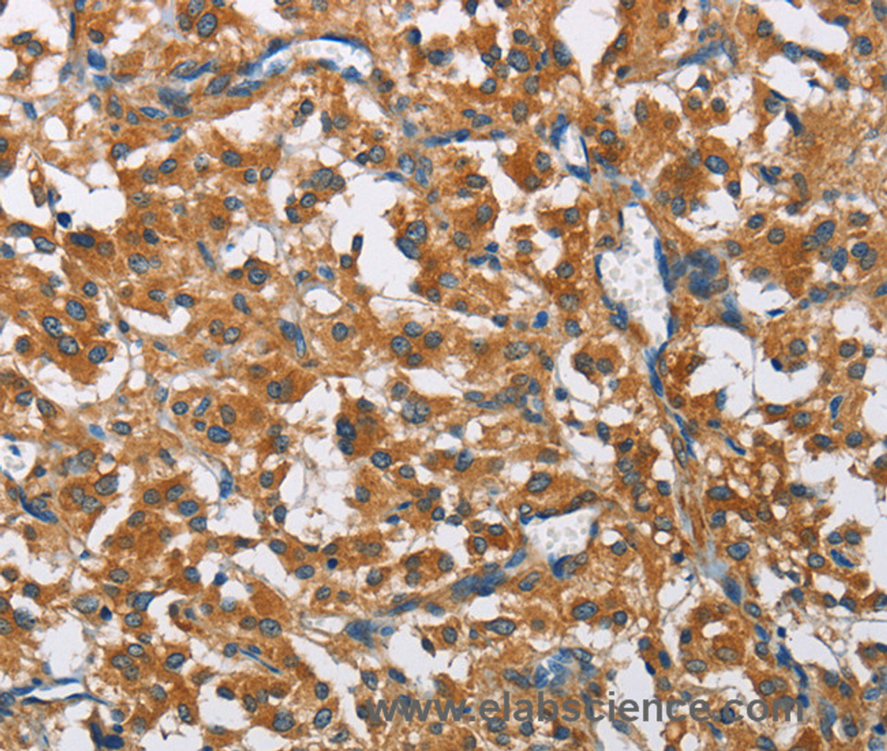 Immunohistochemistry of paraffin-embedded Human thyroid cancer using COPB1 Polyclonal Antibody at dilution of 1:50