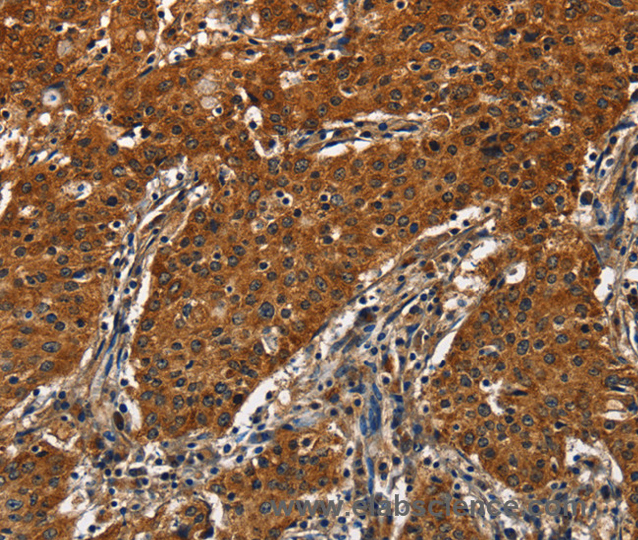 Immunohistochemistry of paraffin-embedded Human gastric cancer tissue using CATSPER4 Polyclonal Antibody at dilution 1:50