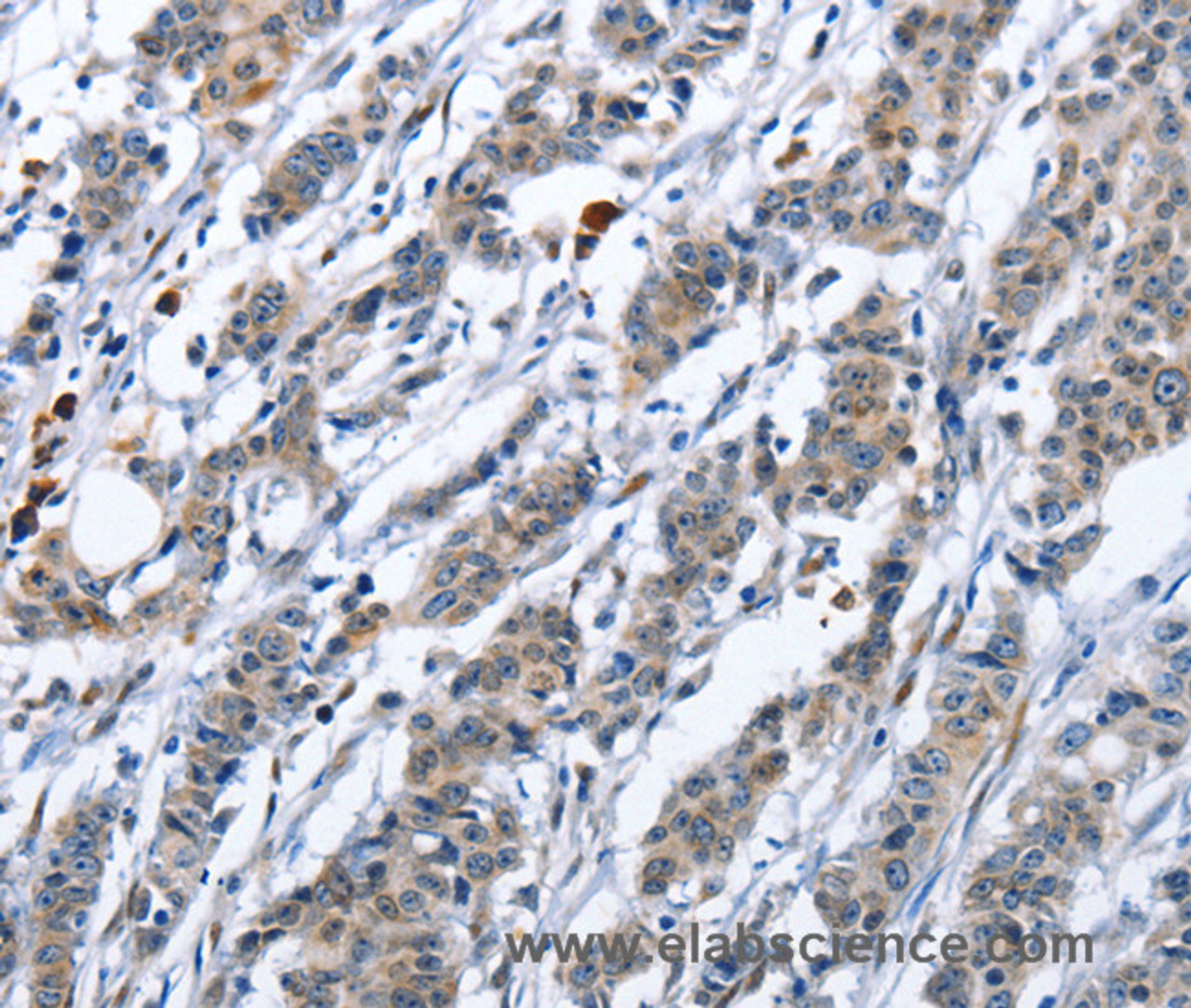 Immunohistochemistry of paraffin-embedded Human cervical cancer tissue using CD137 Polyclonal Antibody at dilution 1:50