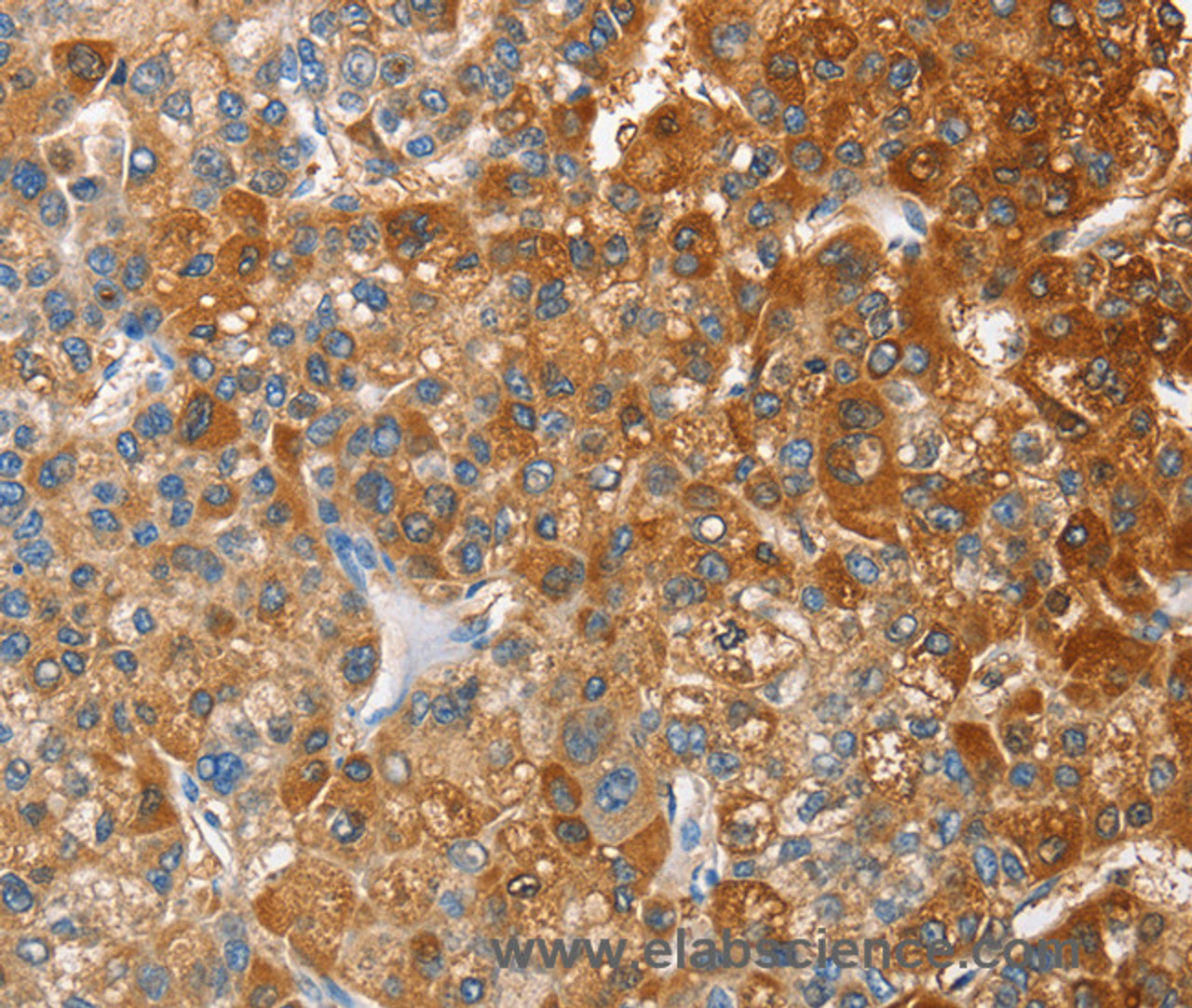 Immunohistochemistry of paraffin-embedded Human liver cancer tissue using OX2R Polyclonal Antibody at dilution 1:60