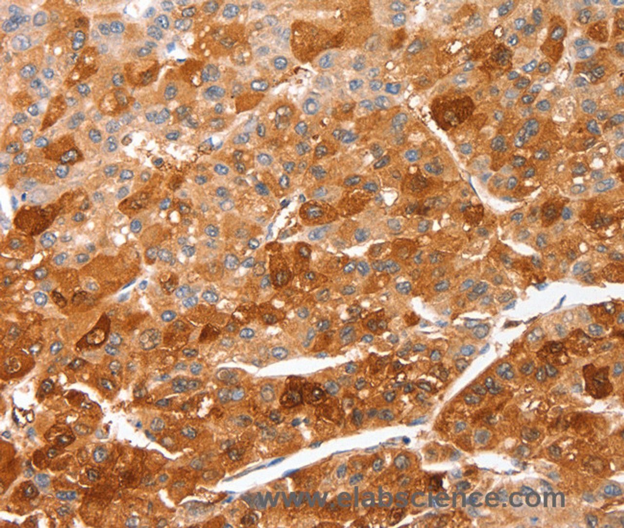 Immunohistochemistry of paraffin-embedded Human liver cancer using CIDEC Polyclonal Antibody at dilution of 1:50