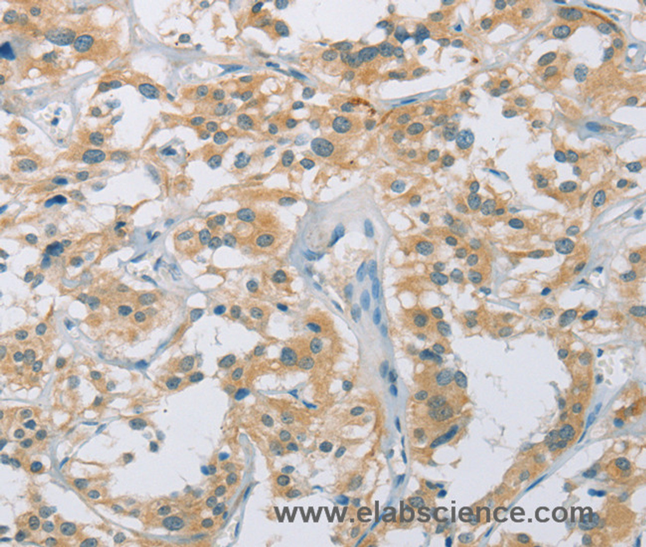 Immunohistochemistry of paraffin-embedded Human thyroid cancer tissue using CYP11B1 Polyclonal Antibody at dilution 1:30