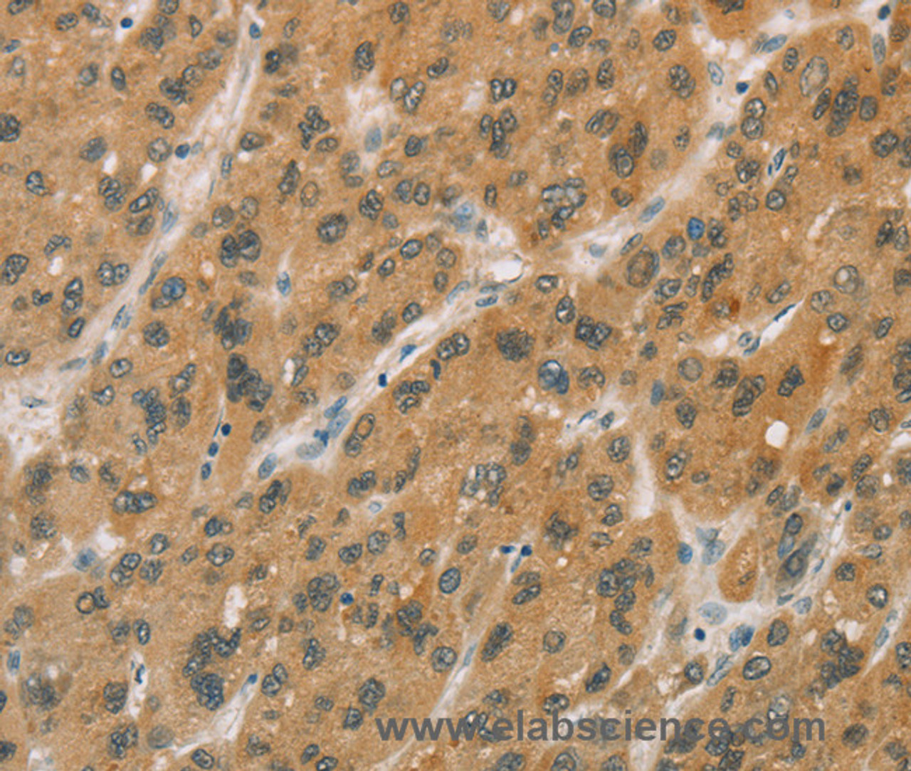 Immunohistochemistry of paraffin-embedded Human liver cancer tissue using CYP11A1 Polyclonal Antibody at dilution 1:50