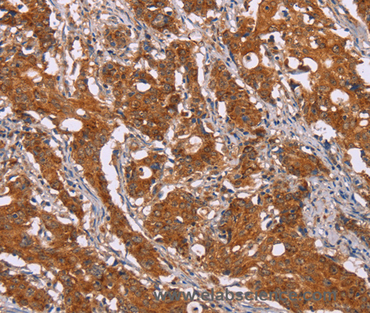 Immunohistochemistry of paraffin-embedded Human gasrtic cancer tissue using DCTN6 Polyclonal Antibody at dilution 1:40