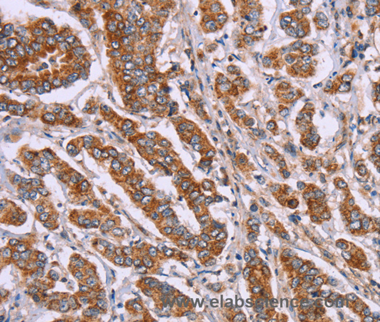 Immunohistochemistry of paraffin-embedded Human breast cancer tissue using DCTN6 Polyclonal Antibody at dilution 1:40