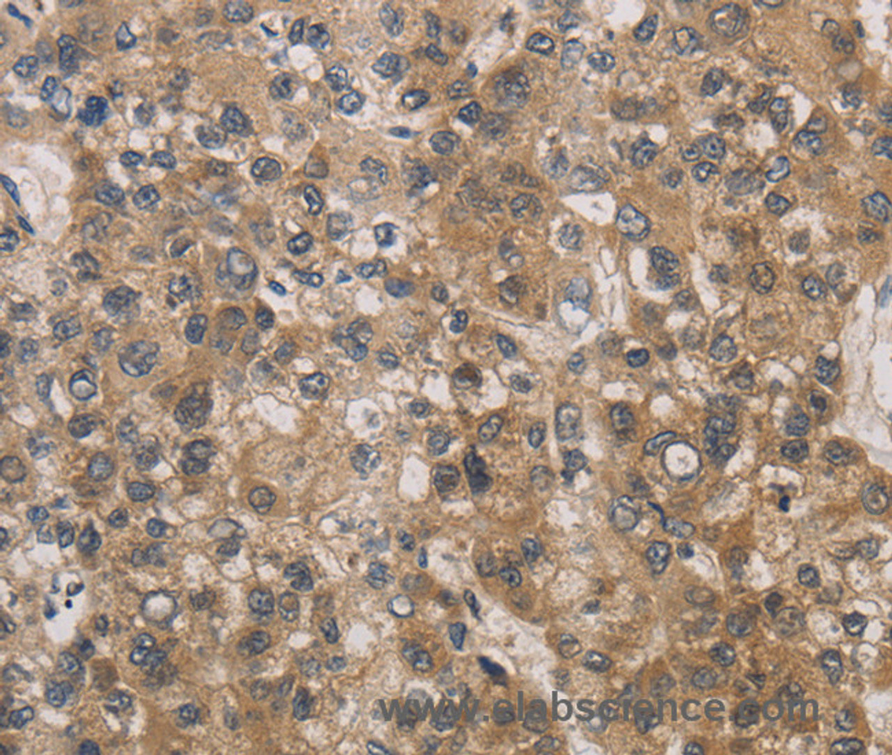 Immunohistochemistry of paraffin-embedded Human liver cancer tissue using DEGS1 Polyclonal Antibody at dilution 1:30